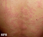 urticaria