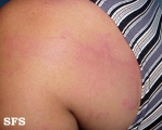 urticaria