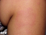 urticaria