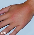 urticaria