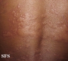 urticaria