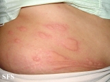 urticaria
