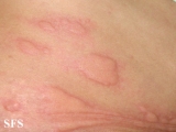 urticaria