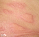 urticaria