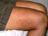 urticaria