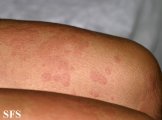 urticaria
