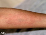 urticaria