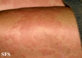 urticaria