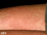 urticaria