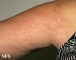 urticaria