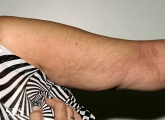 urticaria