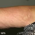 urticaria