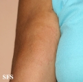 urticaria