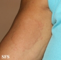 urticaria