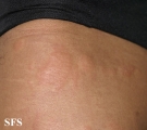 urticaria