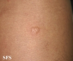 urticaria