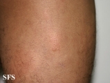 urticaria