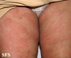 urticaria