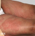urticaria