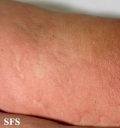urticaria
