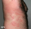 urticaria