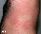 urticaria