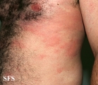 urticaria