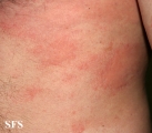 urticaria