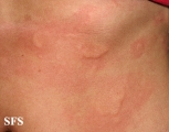 urticaria