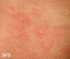 urticaria