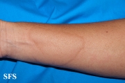 urticaria