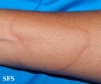urticaria