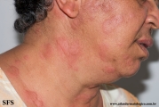 urticaria