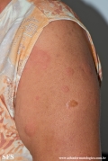 urticaria
