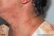 urticaria