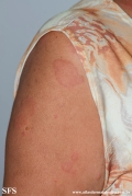 urticaria