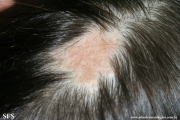 aplasia cutis congenita