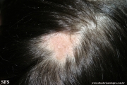 aplasia cutis congenita