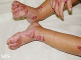 acrodermatitis enteropathica