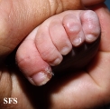 acrodermatitis enteropathica