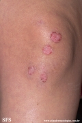 acrodermatitis enteropathica