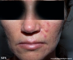 acne rosacea