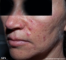 acne rosacea
