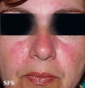 acne rosacea