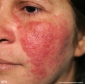 acne rosacea