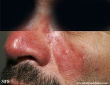 acne rosacea