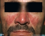 acne rosacea