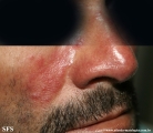 acne rosacea