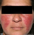 acne rosacea