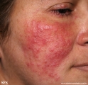 acne rosacea